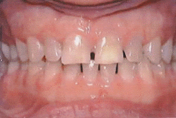 bruxismo, digrignamento dei denti
